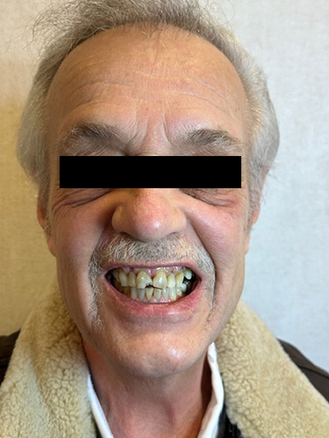 Before Image: Veneers - front