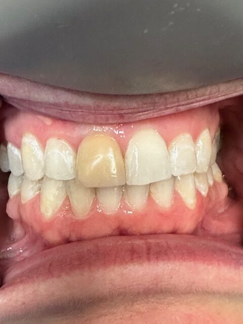 Before Image: Veneers - front