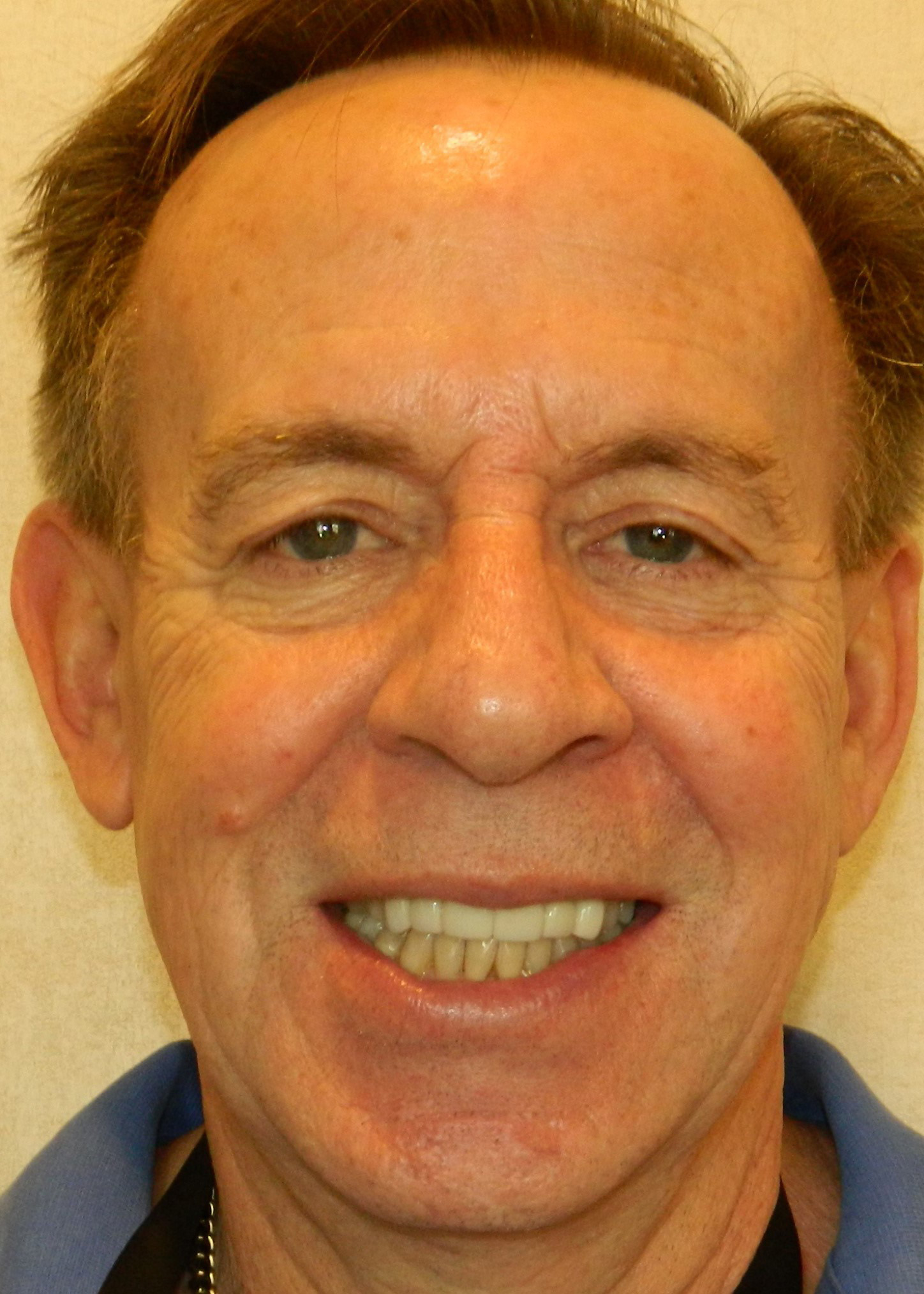 After Image: Veneers - front