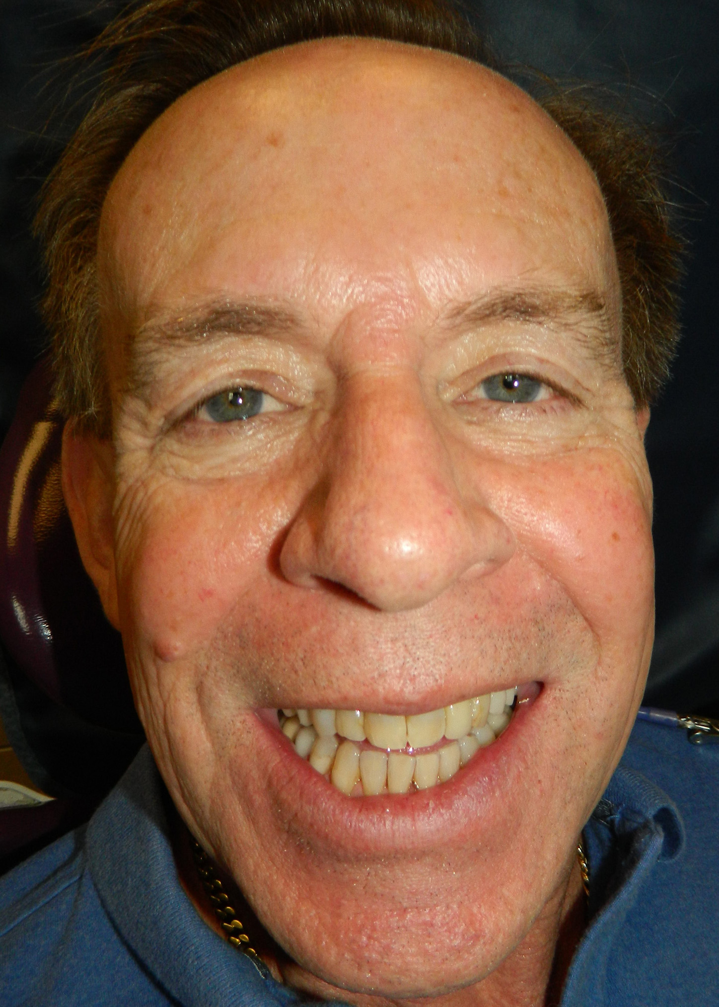 Before Image: Veneers - front