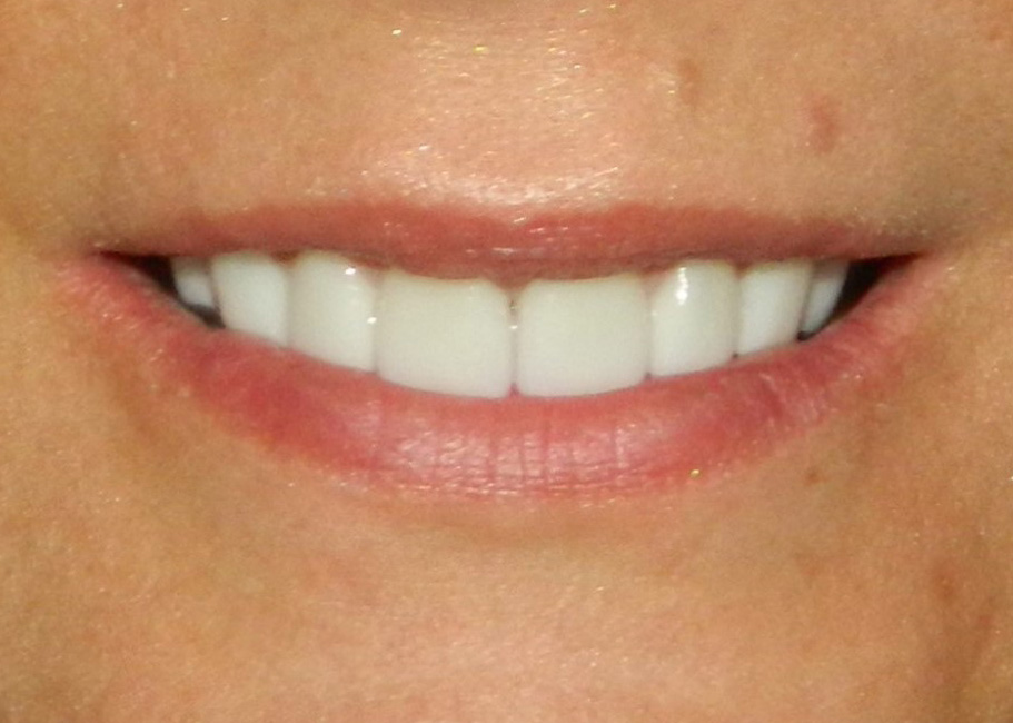 After Image: Veneers - front