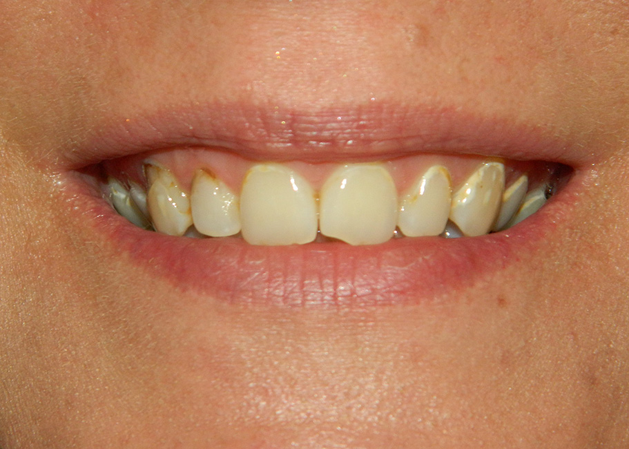 Before Image: Veneers - front