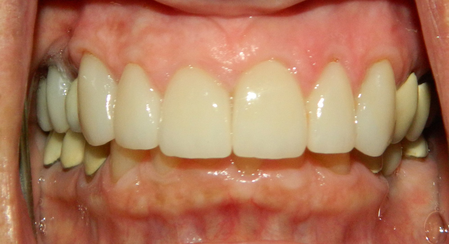 After Image: Veneers - front
