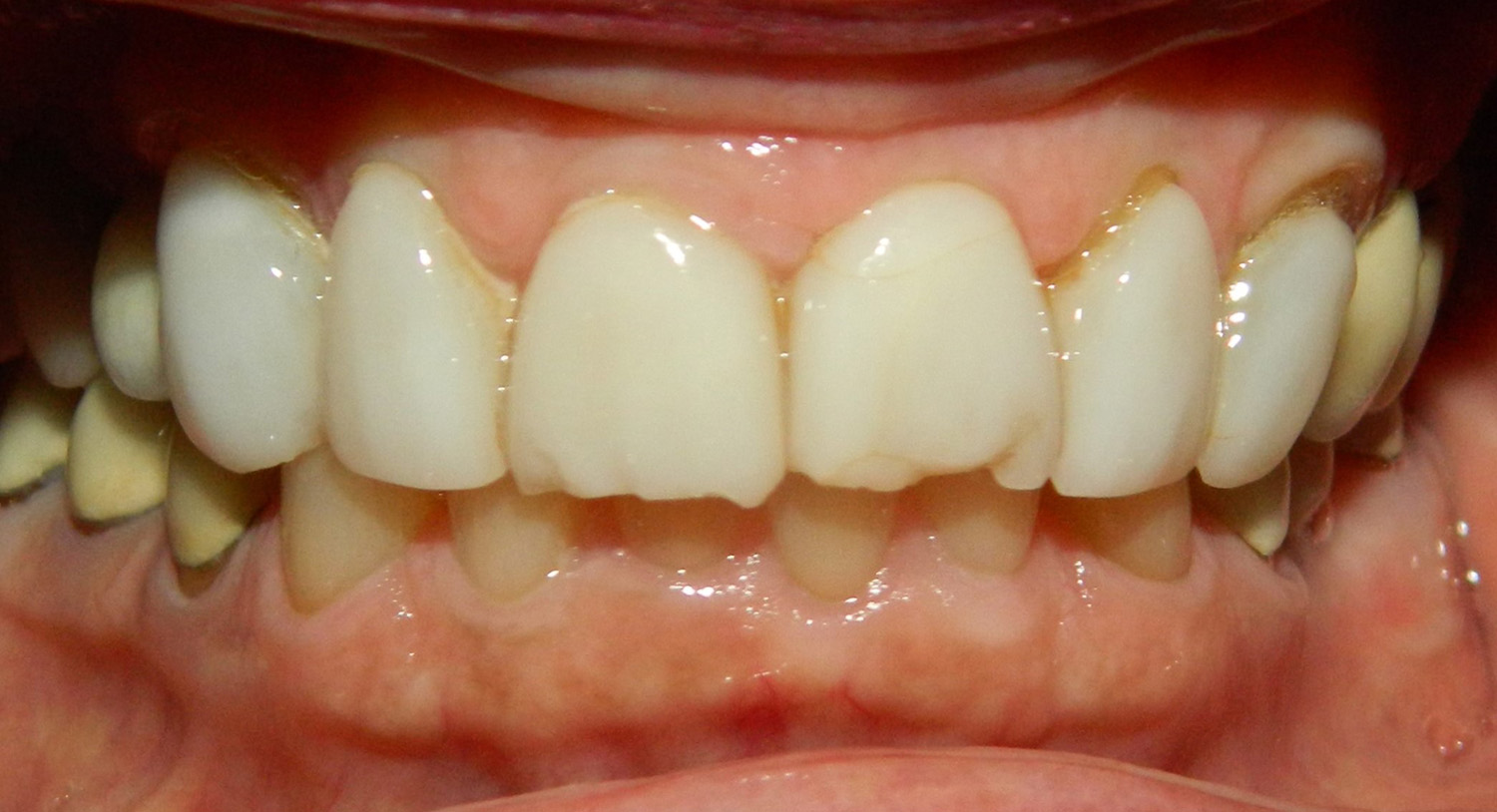 Before Image: Veneers - front