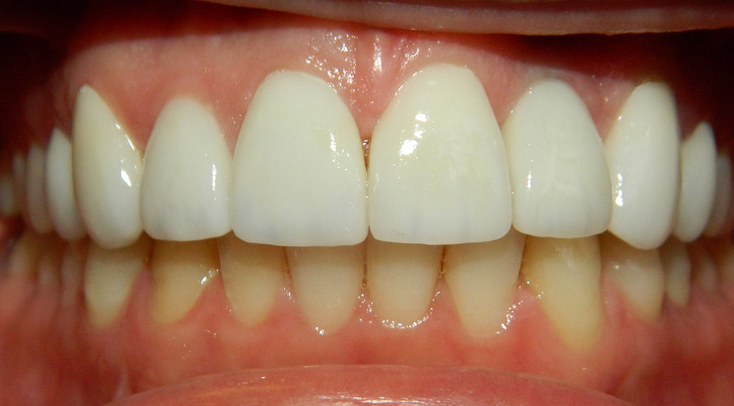 After Image: Veneers - front