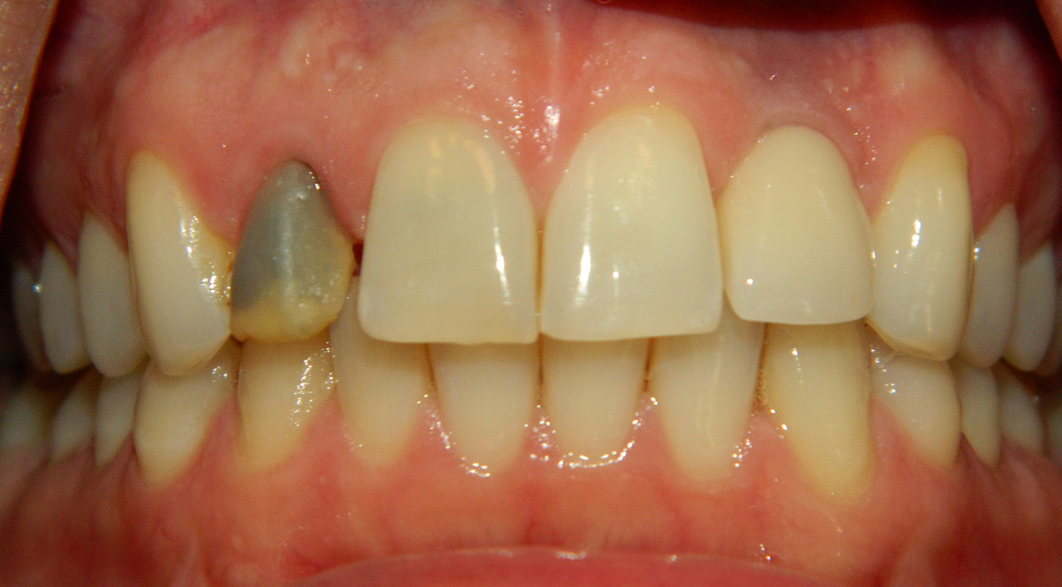 Before Image: Veneers - front