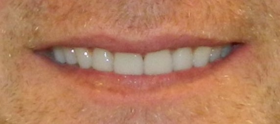After Image: Veneers - front