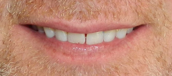 Before Image: Veneers - front