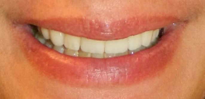 After Image: Veneers - front