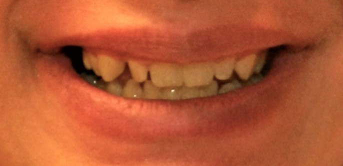 Before Image: Veneers - front