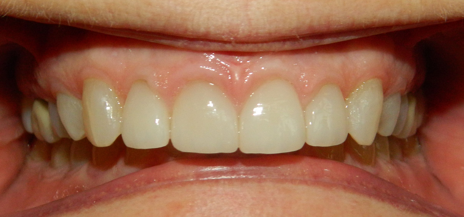 After Image: Veneers - front
