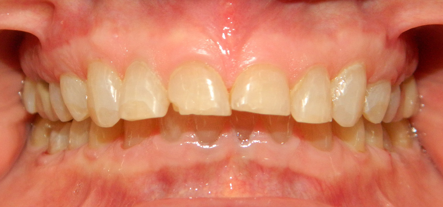 Before Image: Veneers - front