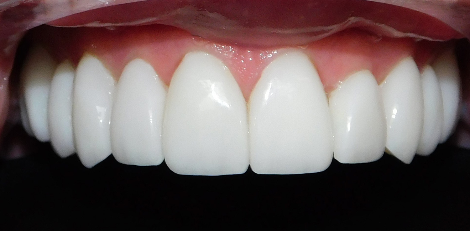 After Image: Veneers - front
