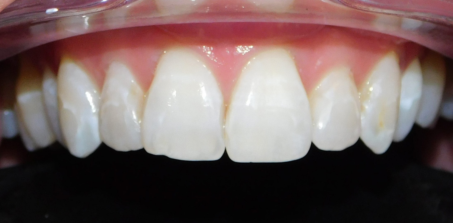Before Image: Veneers - front