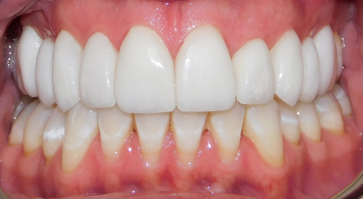 After Image: Veneers - front