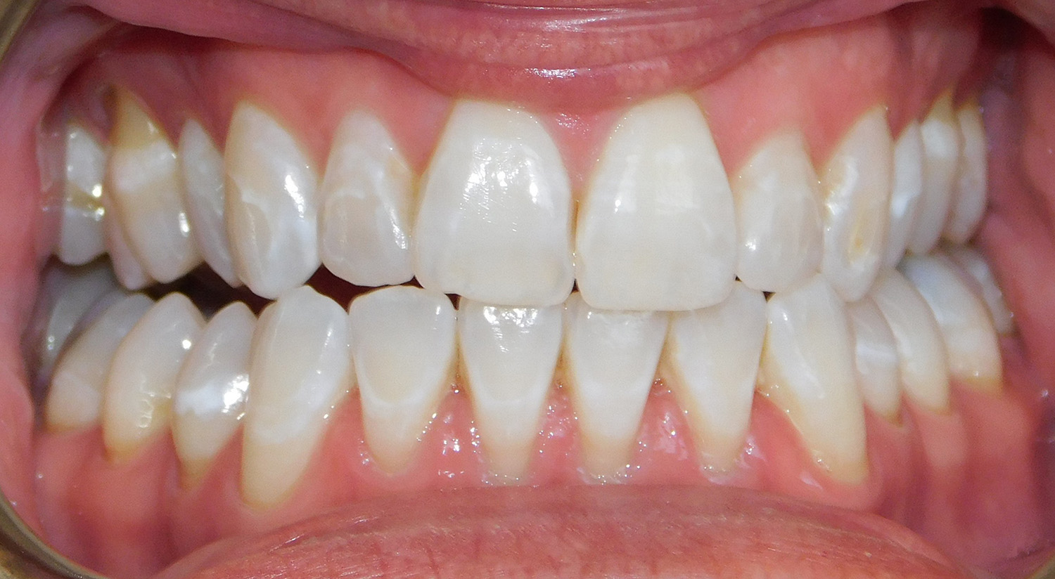 Before Image: Veneers - front