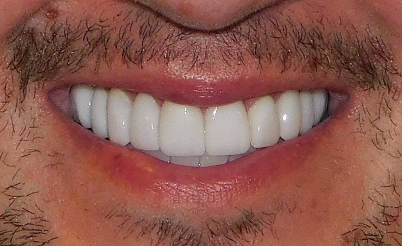 After Image: Veneers - front