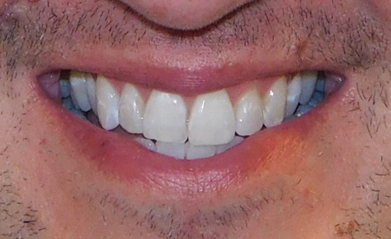 Before Image: Veneers - front