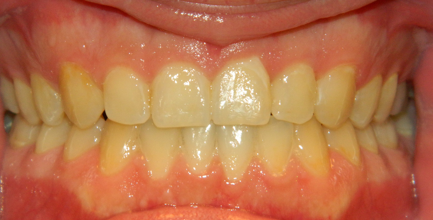 Before Image: Zoom Whitening - front