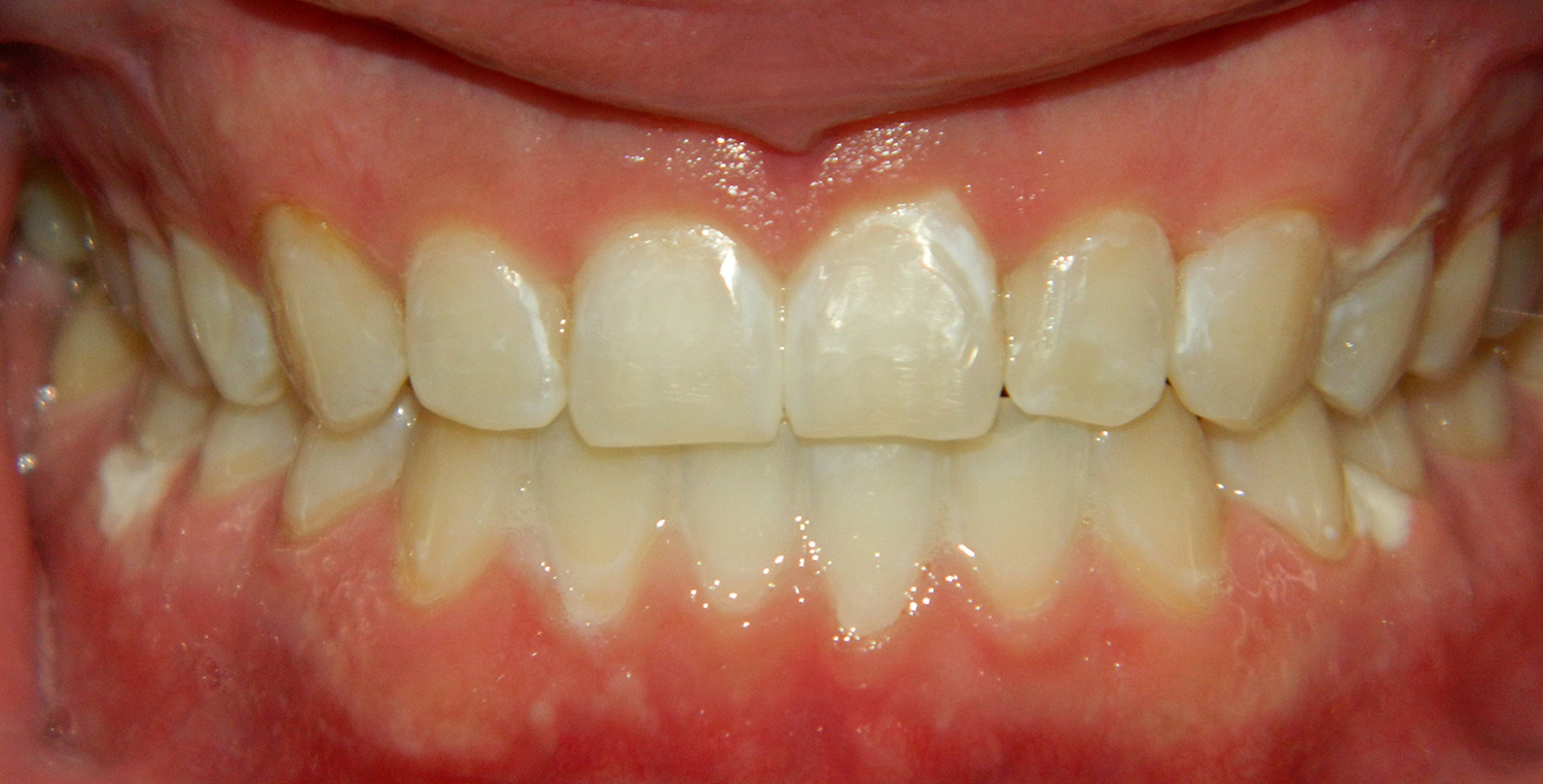After Image: Zoom Whitening - front