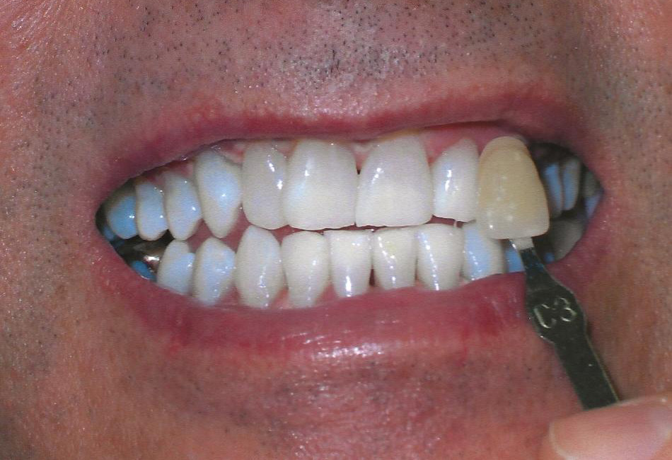 After Image: Zoom Whitening - front
