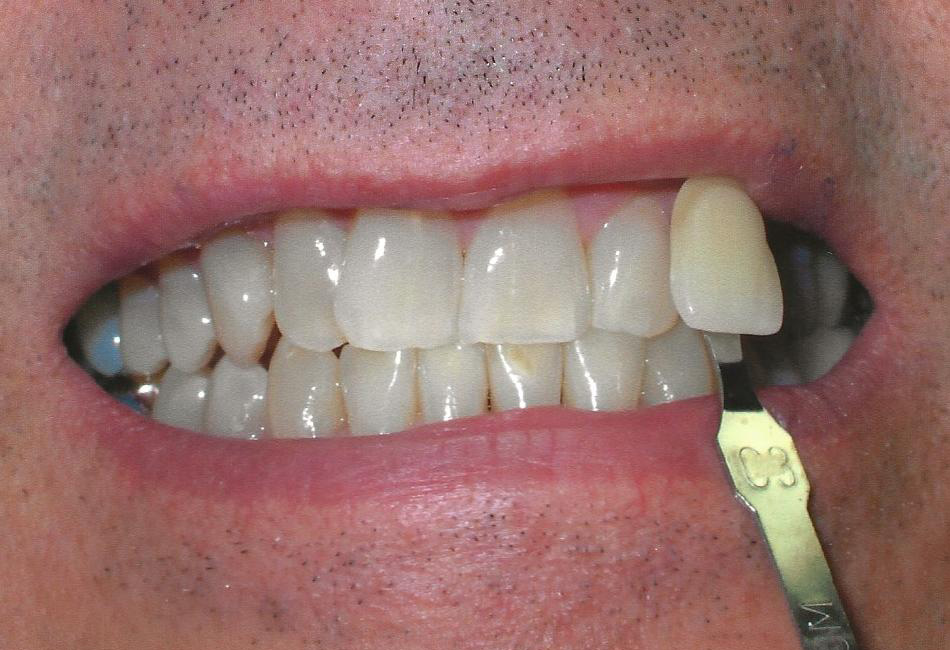 Before Image: Zoom Whitening - front