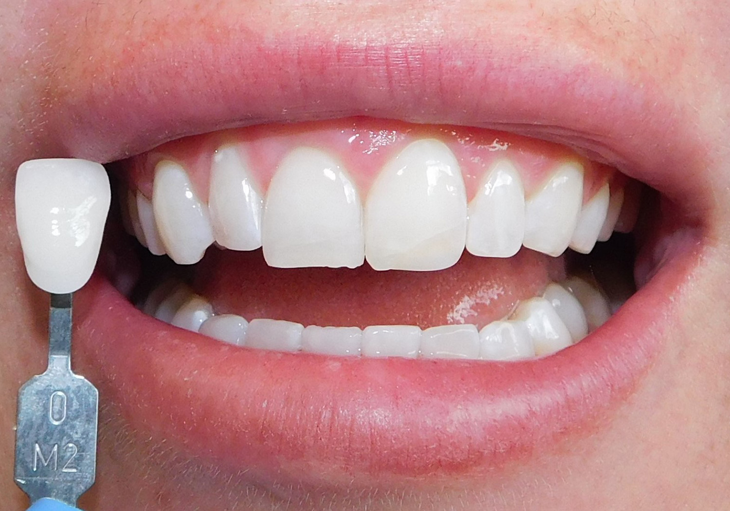 After Image: Zoom Whitening - front