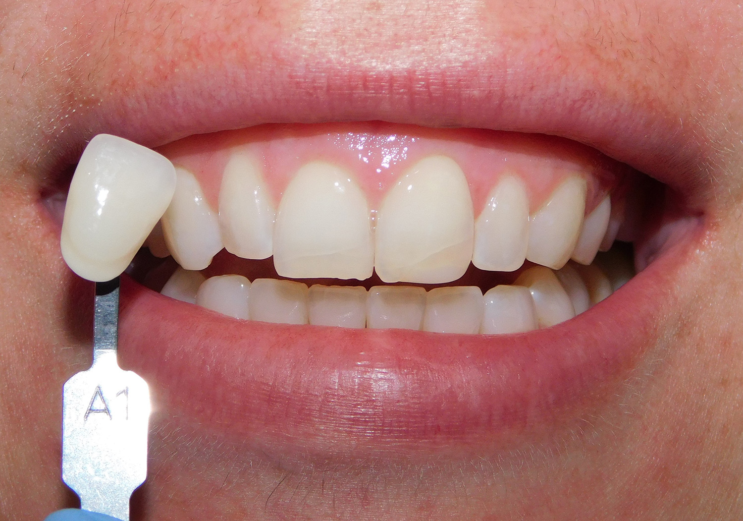 Before Image: Zoom Whitening - front