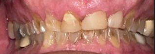 Before Image: Veneers - front