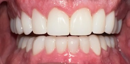After Image: Veneers - front