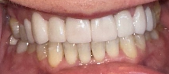 After Image: Veneers - front
