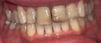 Before Image: Veneers - front