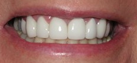 After Image: Veneers - front