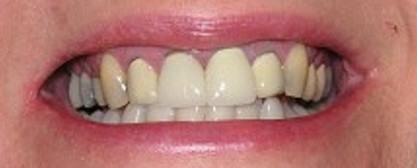 Before Image: Veneers - front