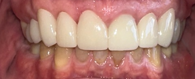 After Image: Veneers - front