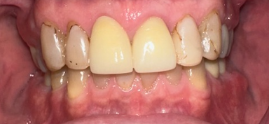 Before Image: Veneers - front