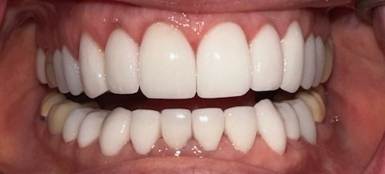 After Image: Veneers - front