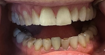 Before Image: Veneers - front