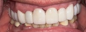 After Image: Veneers - front