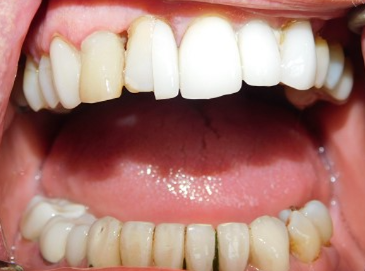 Before Image: Veneers - front