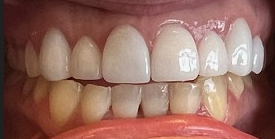 After Image: Veneers - front