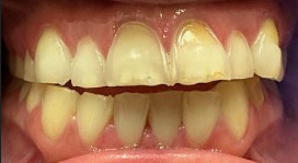 Before Image: Veneers - front