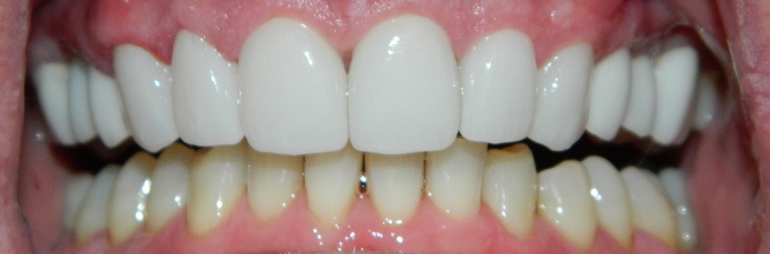 After Image: Veneers - front