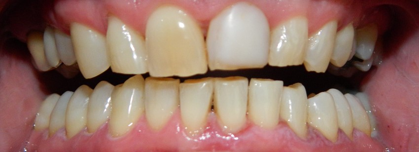 Before Image: Veneers - front
