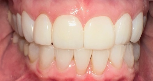 After Image: Veneers - front