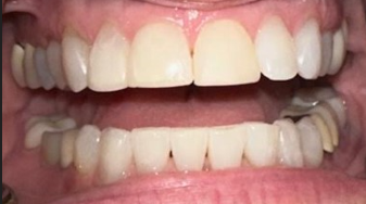 Before Image: Veneers - front