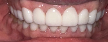 After Image: Veneers - front
