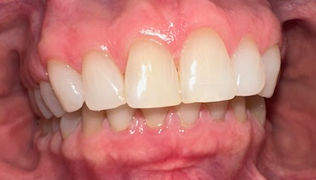 Before Image: Veneers - front