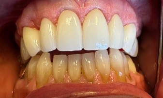 After Image: Veneers - front