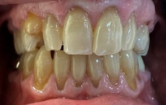 Before Image: Veneers - front